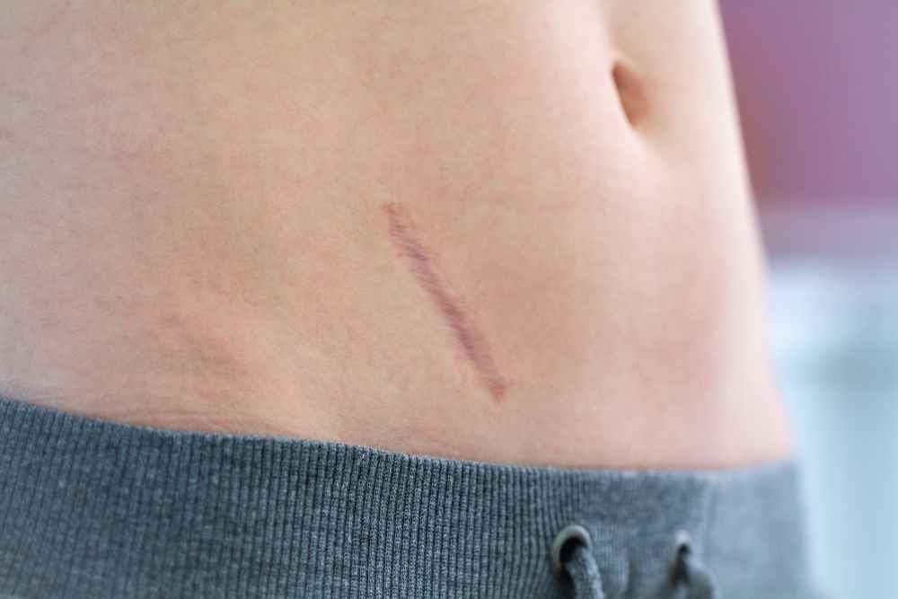 cicatriz hipertrófica con tratamiento